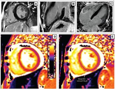 The Role of Multimodality Imaging in HIV-Associated Cardiomyopathy